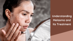 Understanding Melasma and Its Treatment