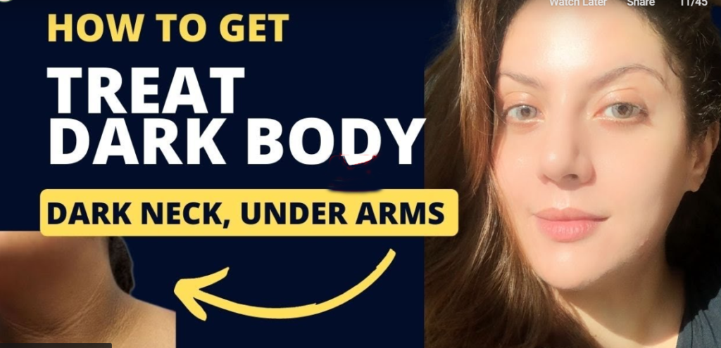 Extreme Body Hyperpigmentation Treatment