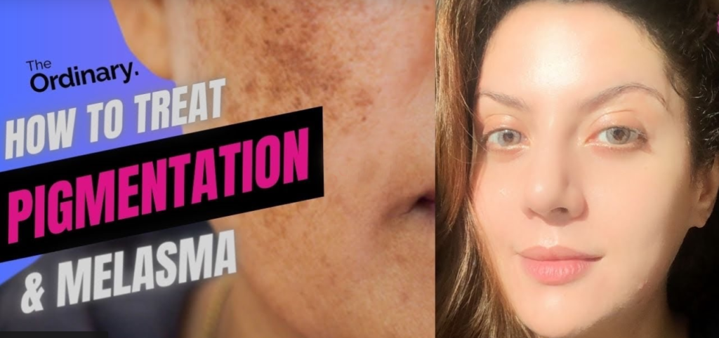 How to Treat Pigmentation at Domestic