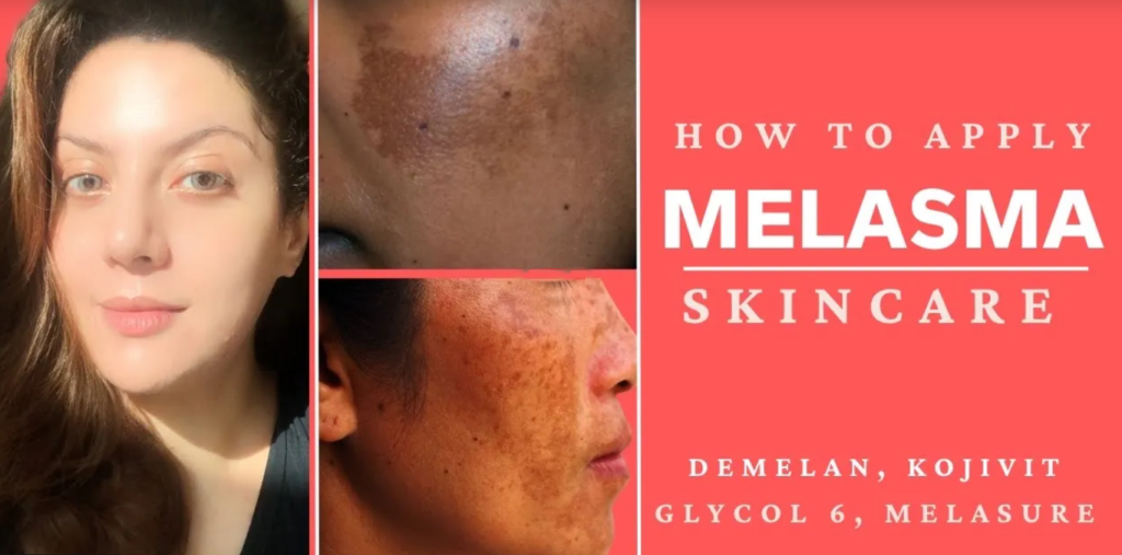 Melasma treatment creams
