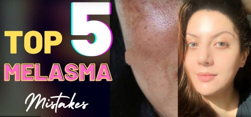 Don’t make these botches if you have Melasma! Best 5 botches that cause Melasma to not blur